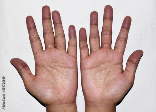 Tablou pe pânză Cyanotic hands or peripheral cyanosis or blue hands at Asian young woman with congenital heart disease