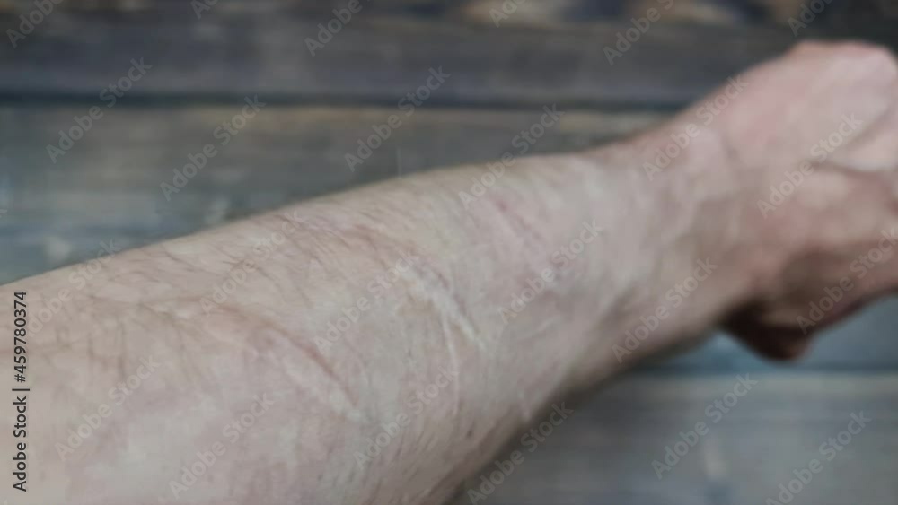 The Scars on the arm. Cut marks on the arm. Hand injuries. Scars on the