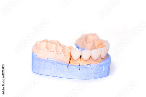 Veneers and crowns isolated on white background. Plaster model of teeth. lower jaw plaster model with prepared teeth. White front teeth veneers on diagnostic model. Concept of cosmetic dentistry