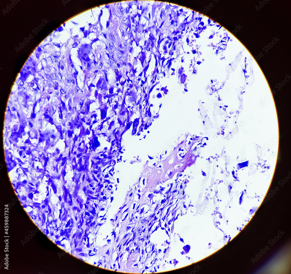 Osteoclast like giant cells. Light micrograph of a giant cell tumour of ...