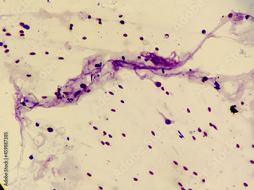 Cytopathology Tissue form breast, microscopic image of granulomatous mastitis, histology photo