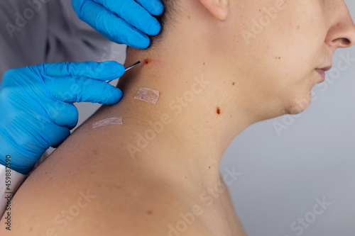 Close-up of the wound that remained after excision of the nevus. Removal and treatment of benign skin lesions. Surgery. Doctor and patient in one shot. Skin disease treatment and surgical care concept