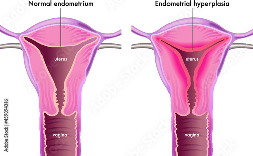 Medical illustration shows a female genital system with a normal endometrium compared with one afflicted of endometrial hyperplasia. photo