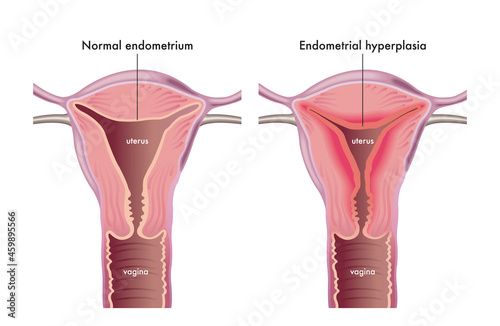Medical illustration shows a female genital system with a normal endometrium compared with one afflicted of endometrial hyperplasia. photo