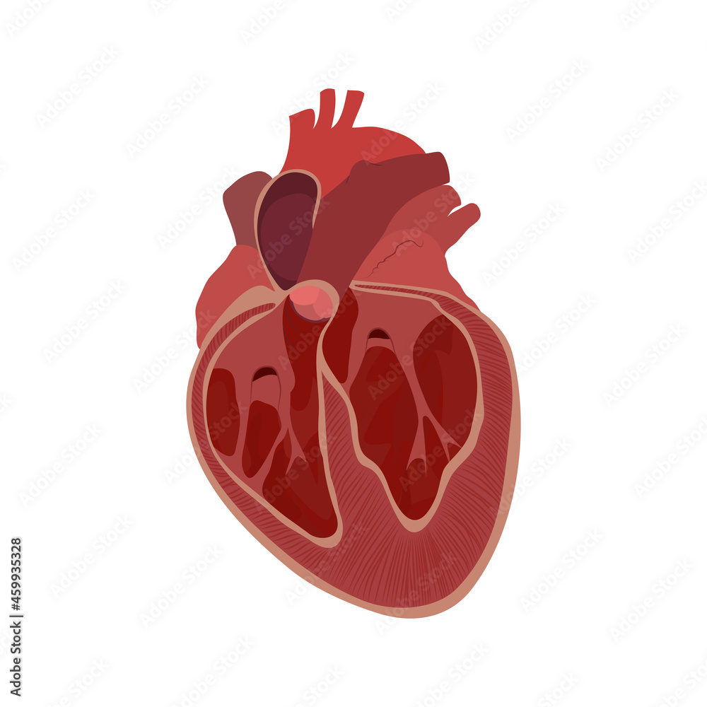 Enlarged heart, cardiomegaly, inner, inside view. Vector flat anatomy