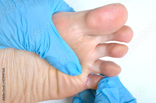 Fungal lesions of the skin of the feet.