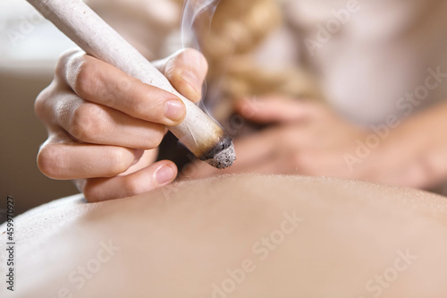 Alternative therapist applying moxibustion a traditional chinese medicine method. Doctor healing young patient with traditional asian medicine. Moxa stick alone. Extreme close up. Moxibustion.