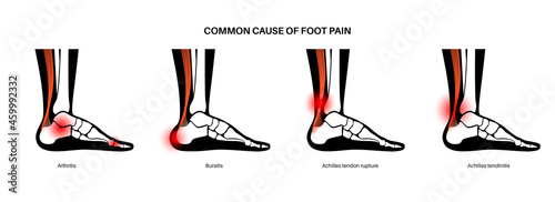 Achilles tendon injury