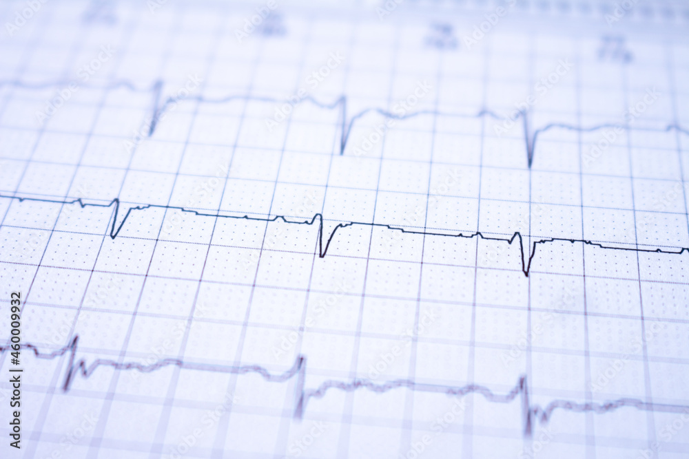 Heart waves recorded on paper called an electrocardiogram. Study of the heart. Heart waves recorded on paper called an electrocardiogram. Study of the heart.