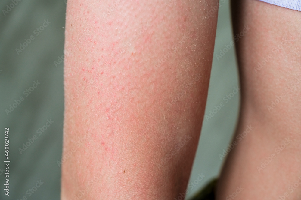 follicular hyperkeratosis is located on the person's arm