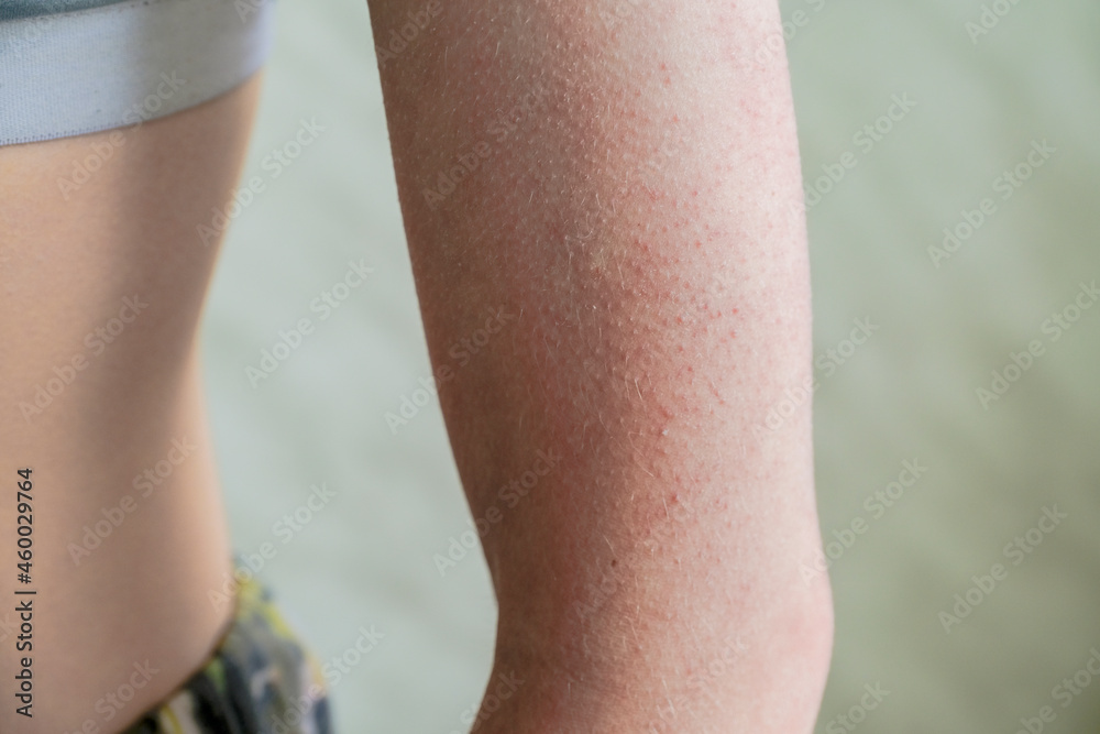 follicular hyperkeratosis is located on the person's arm follicular hyperkeratosis is located on the person's arm