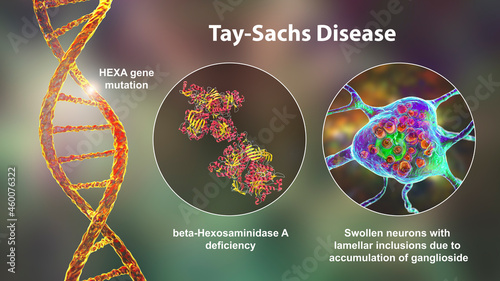 Tay-Sachs disease, 3D illustration photo