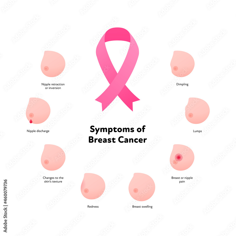 Fototapeta premium Breast cancer symptoms infographic. Vector flat healthcare illustration. Set of icon symbol with symptom and text isolated on white background. Pink ribbon symbol. Design for awarness month, poster