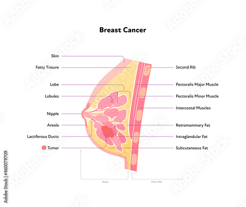 Human breast anatomy diagram. Vector flat medical illustration. Side view section chart with text and tumor cell isolated on white background. Design for healthcare, science. photo