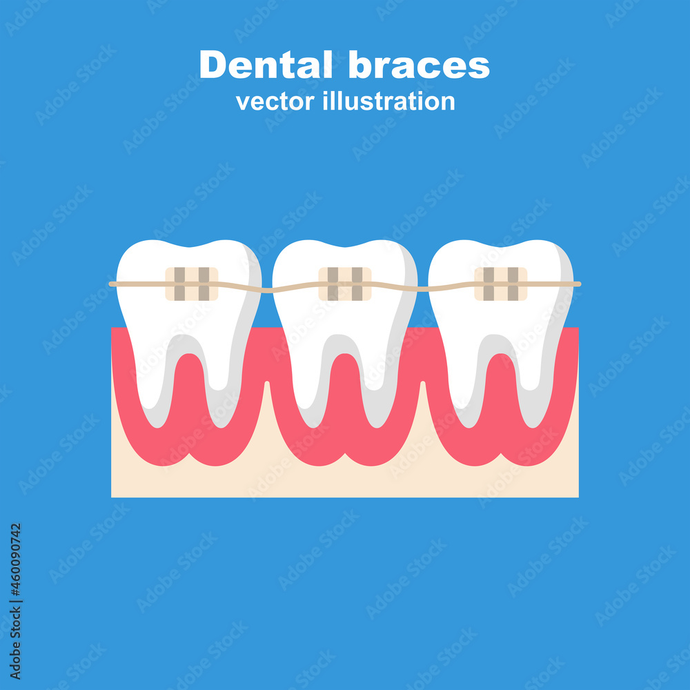 Dental braces. Teeth with braces. Leveling teeth. Orthodontic treatment