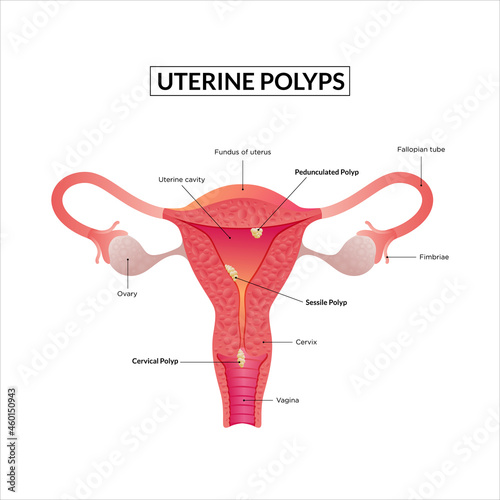 Types of Uterine Polyp. Female reproductive system diseases.