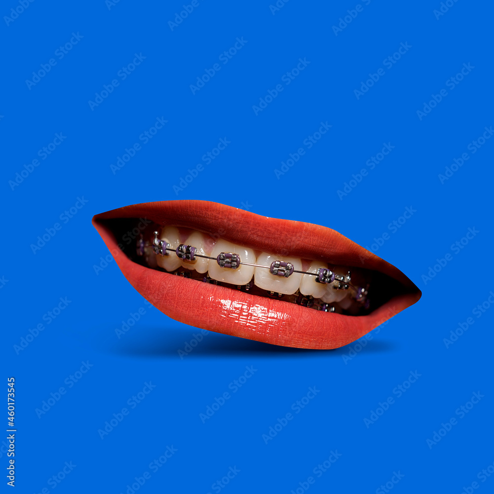 Modern contemporary collage mouth with braces smiling, digital art composition with dental braces Modern contemporary collage mouth with braces smiling, digital art composition with dental braces