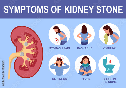 Kidney stone symptom infographic in flat design vector illustration. photo