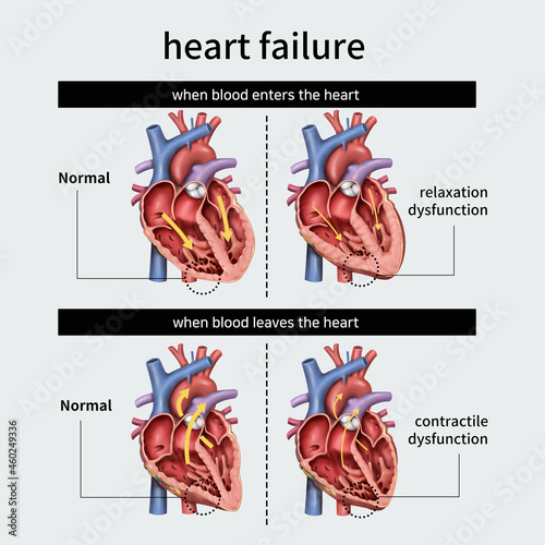 Canvastavla 심부전 heart failure