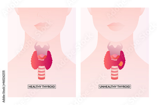 Healthy Thyroid gland and unhealthy thyroid with Inflammation and lump, thyroid cancer concept.