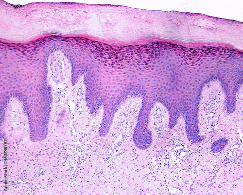 Human skin. Lichen planus. Hyperkeratosis, acanthosis and long dermal papillae  photo