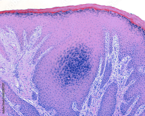 Papilloma caused by human papillomavirus (HPV). Hypergranulosis) photo