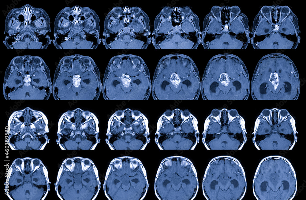 MRI Brain with and without contrast media Findings: There is a 3.5cm ...