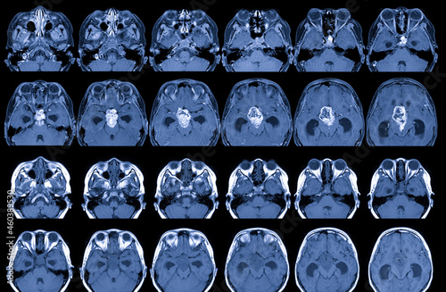 MRI Brain with and without contrast media Findings: There is a 3.5cm diameter lobulated mass at suprasellar with compression of  the pituitary gland,Medical healthcare concept. photo