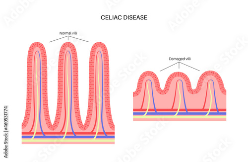 Celiac disease inflammation