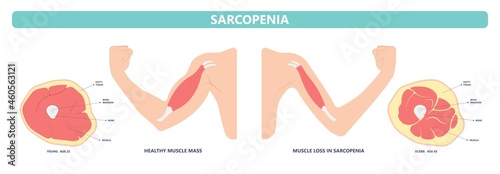 Muscle pain nerve waste injury arm leg lack diet limb nutrition body activity lateral Guillain Barre loss tissue Atrophied poor genetic older frailty Spinal gene mass Polio cord Aging adults body BMI