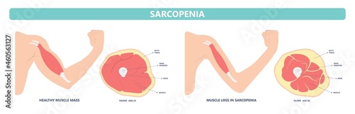 Muscle pain nerve waste injury arm leg lack diet limb nutrition body activity lateral Guillain Barre loss tissue Atrophied poor genetic older frailty Spinal gene mass Polio cord Aging adults body BMI