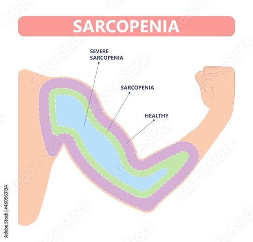 Muscle pain nerve waste injury arm leg lack diet limb nutrition body activity lateral Guillain Barre loss tissue Atrophied poor genetic older frailty Spinal gene mass Polio cord Aging adults body BMI