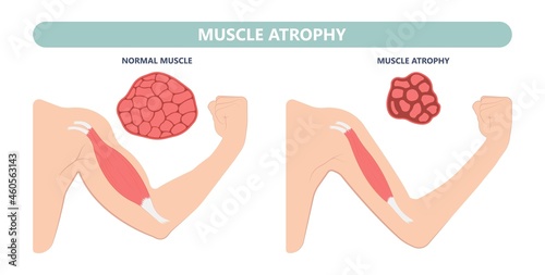 Muscle pain nerve waste injury arm leg lack diet limb nutrition body activity lateral Guillain Barre loss tissue Atrophied poor genetic older frailty Spinal gene mass Polio cord Aging adults body BMI
