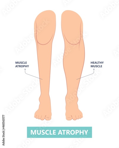 Muscle pain nerve waste injury arm leg lack diet limb nutrition body activity lateral Guillain Barre loss tissue Atrophied poor genetic older frailty Spinal gene mass Polio cord Aging adults body BMI