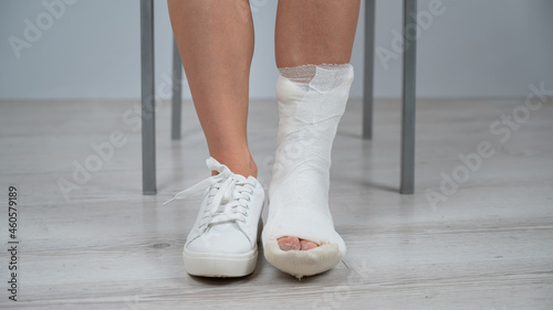 Close-up of female legs with plaster cast. A woman with a broken leg sits on a chair