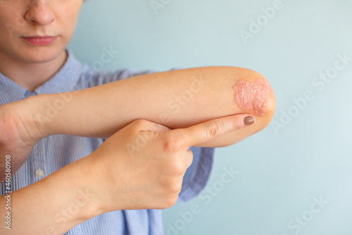 Psoriasis of a women on her elbows, sitting on the bedroom floor. Concept dermatology, skin diseases and care