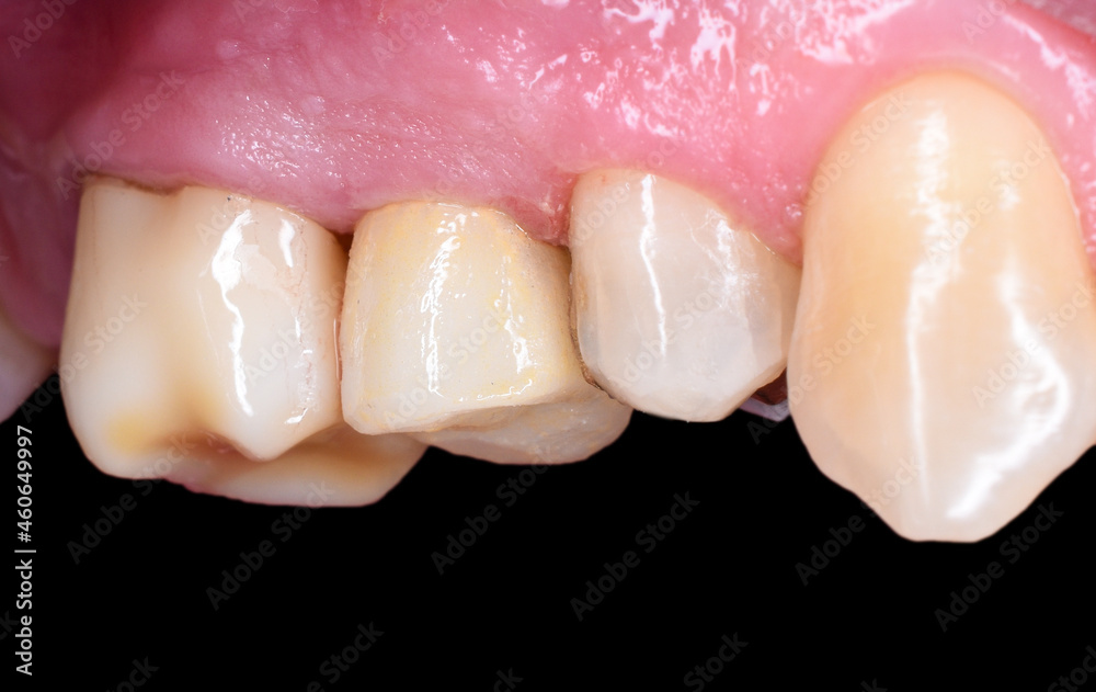 Obraz premium old metal ceramic crown replacment with new ceramic crown