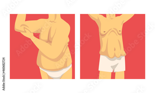 Male Torso with Sagging Belly and Soft Muscles Vector Set