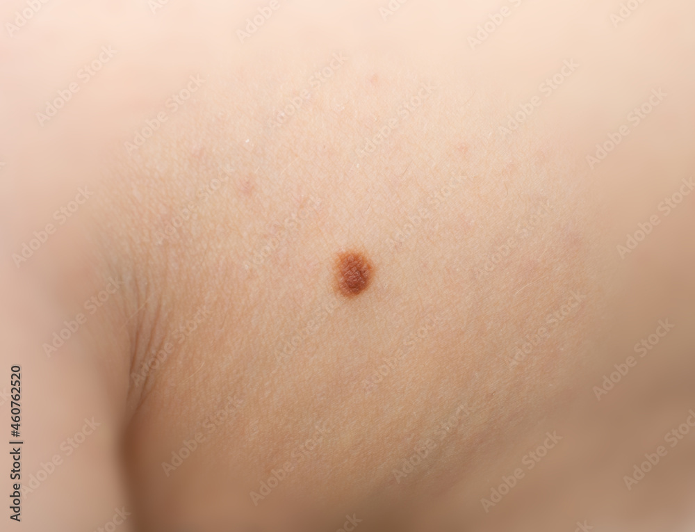 Skin mole closeup. Macro photo of blemish similar to melanoma