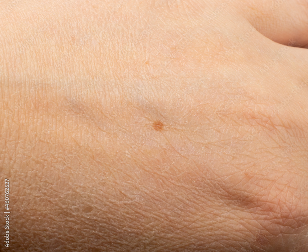 Skin mole closeup. Macro photo of blemish similar to melanoma
