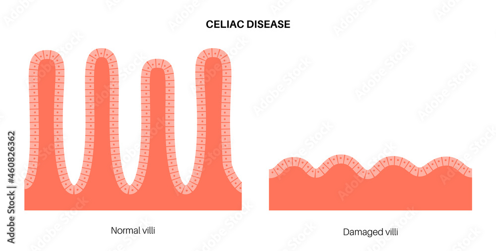 Celiac disease inflammation Stock Vector | Adobe Stock