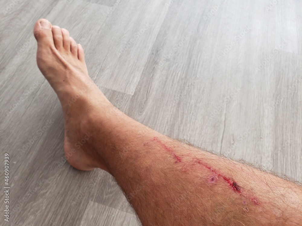 An isolated shin injury closeup image of a large scrape or cut with