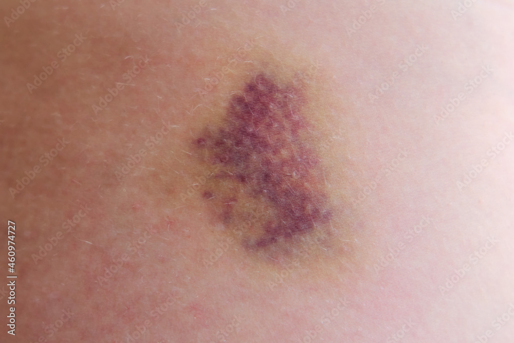 Fototapeta premium Large bruise on the human body, close up