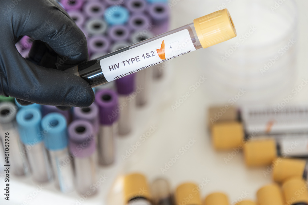Close-up of positive blood sample from VIH typo 1 and 2.