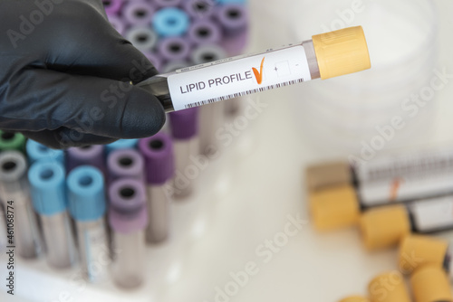 Картината върху платно Close-up of positive blood sample from lipid profile.