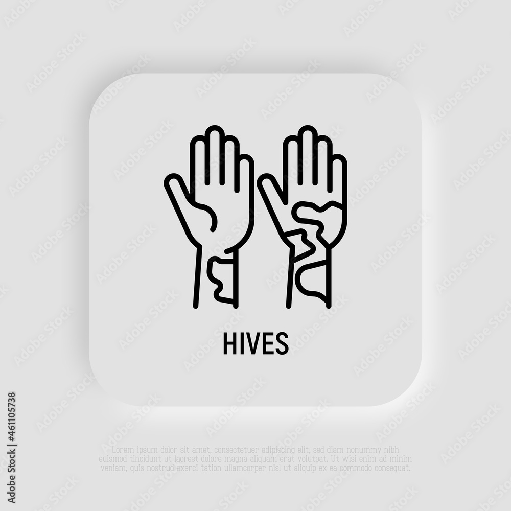 Hives on hand thin line icon. Allergy symptom. Modern vector illustration of allergic reaction. Hives on hand thin line icon. Allergy symptom. Modern vector illustration of allergic reaction.