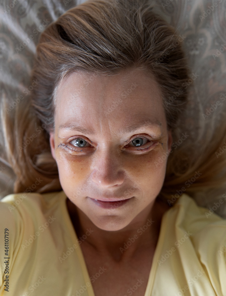 Middle-aged woman selfie seven days after Double Eyelid blepharoplasty surgery. Middle-aged woman selfie seven days after Double Eyelid blepharoplasty surgery.