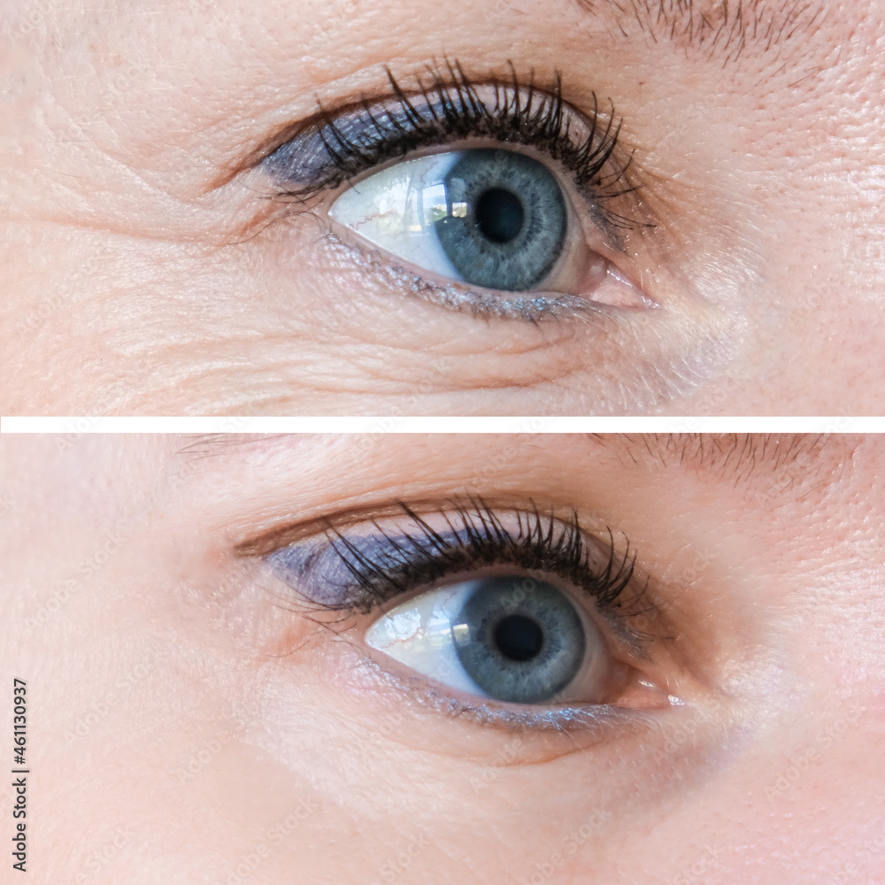 Fototapeta premium Woman face, eye wrinkles before and after treatment - the result of rejuvenating cosmetological procedures of biorevitalization, face lifting and pigment spots removal