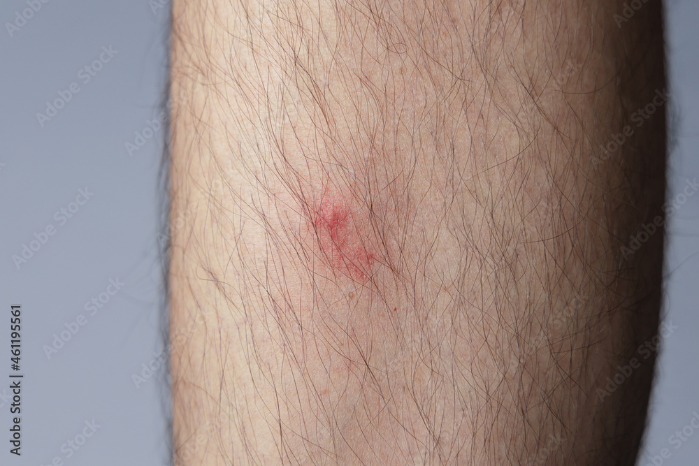 Itchy mosquito bite on male’s leg. Aedes albopictus or tiger mosquito Itchy mosquito bite on male’s leg. Aedes albopictus or tiger mosquito