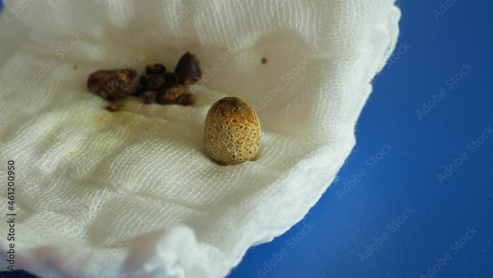 Removed gallstones on compress after gallbladder laparoscopic surgery